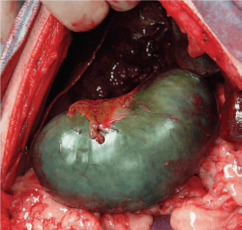 gallbladder mucocele treatmet