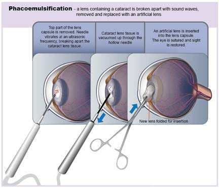 cataract in dogs and cats