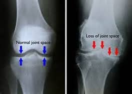 example of knees with arthritis