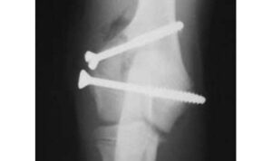 cat fracture