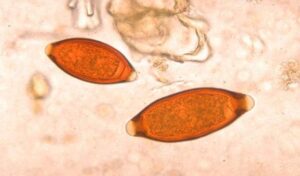 eggs from whipworm infection